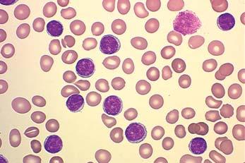 CLL CML Treatment of chronic leukemias Chronic lymphocytic leukemia: rituximab, steroids, fludarabine, bendamustine, ibrutinib.