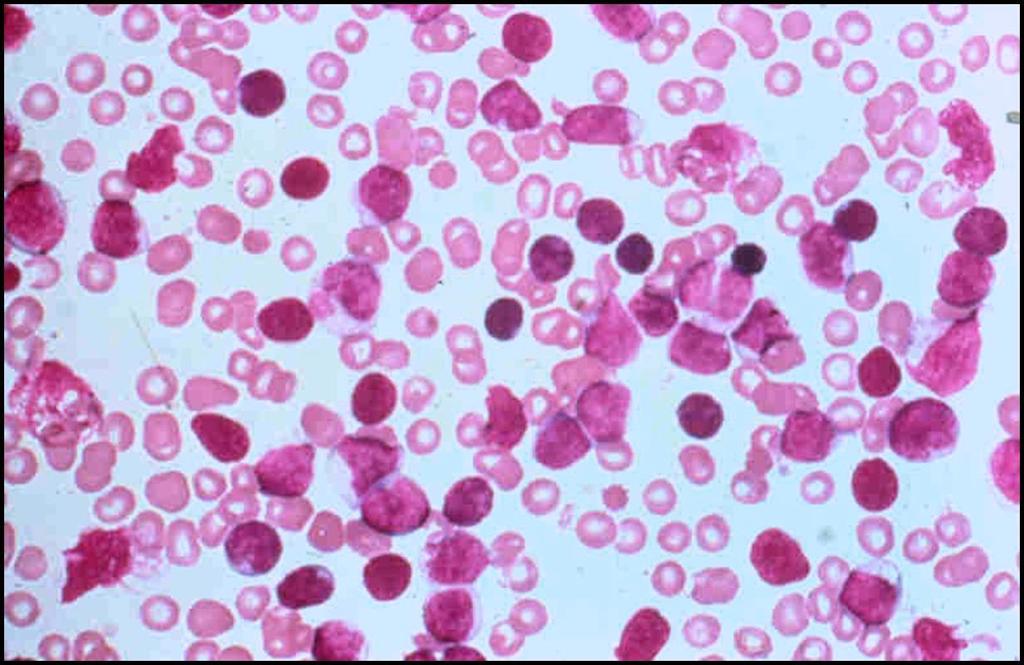 T- cell lymphoblas3c