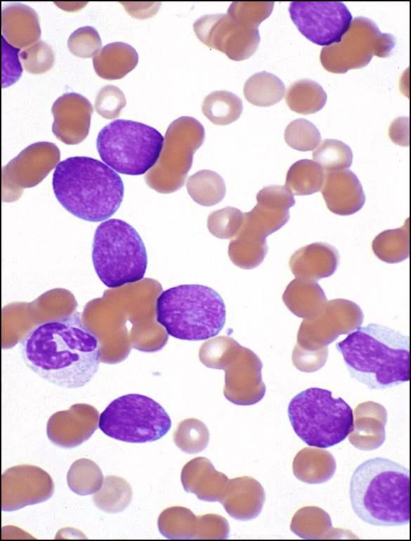 Chronic Myeloid Leukemia, BCR-ABL1 positive (update 2016) Name change to myeloid New definition of lymphoid blast crisis Any lymphoblast(s) in the PB raise concern for blast crisis Cases