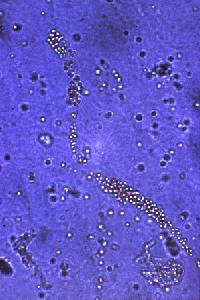 Urine sediment: microscopic examination from freshly passed urine Looking for cells, casts