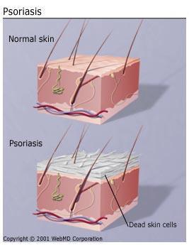 The five main types of psoriasis are plaque, guttate, inverse, pustular, and erythrodermic.