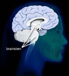 Autistic Brain Brainstem Smaller areas of brainstem sub-regions in mentally and non-mentally retarded juvenile young