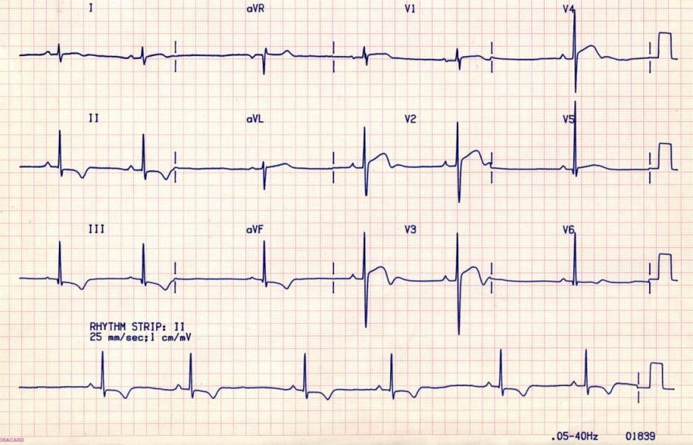 ECG in Patients with Cardiomyopathy Inferior and/or