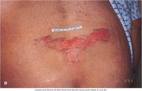 Non-Surgical Management Encompasses both preventative measures and effective therapies used to treat pressure ulcers.