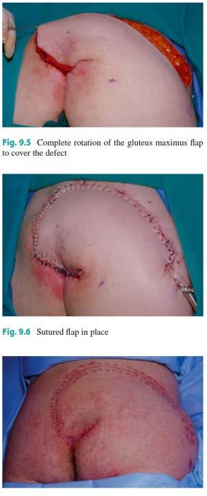 Flap Management of Sacral Pressure Ulcer Gluteus Maximus muscle most commonly used for repair Recommended for