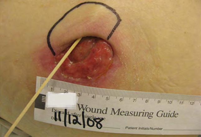 Wound Measurement Measure depth use a cotton tipped applicator to measure the vertical distance to the deepest area in the wound
