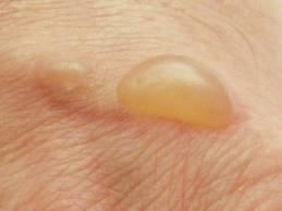 DEFINITIONS BLISTER local swelling of the skin that contains