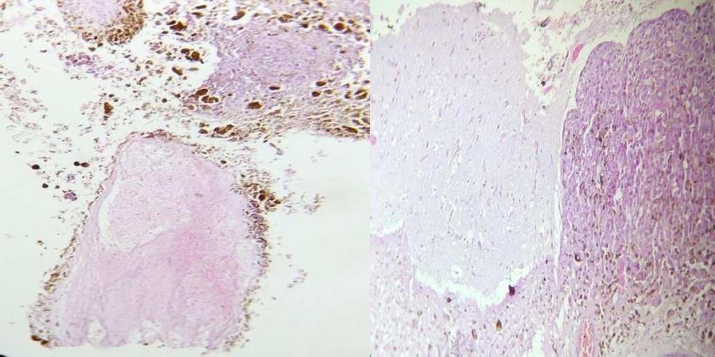 A B C D A Cerebral parenchyma laminated by malignant tumor prolifération of