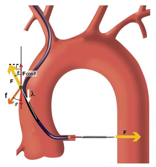 The Physics of Guiding Catheters for Left Coronary Artery in