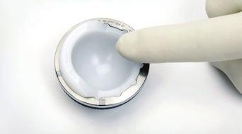 If inserting by hand, spin the liner until scallops engage. Note: Before impaction, the polyethylene liner will not be flush with the rim of the Shell.