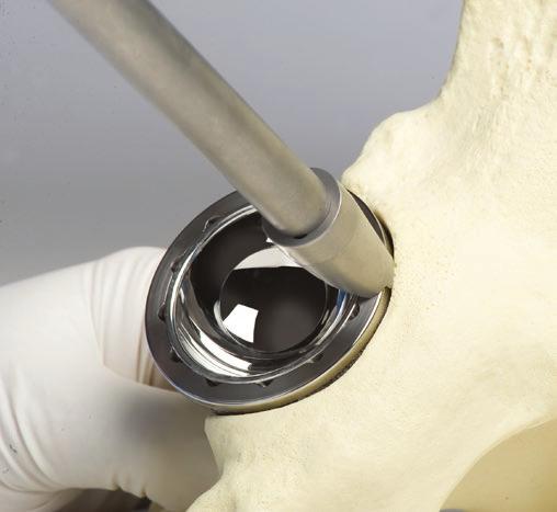 14 Surgical Technique In the case of revisions, involving possible breakage of ceramic components, the recommendation is to either use a ceramic on polyethylene or a ceramic on ceramic articulation.