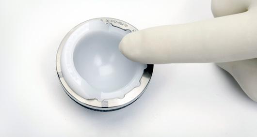 Place the final polyethylene liner into the implanted Shell by hand, or use the Liner Insertion Instrument. If inserting by hand, spin the liner until scallops engage.