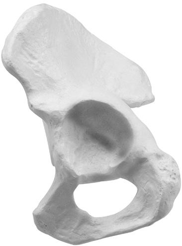 Trilogy IT Acetabular System Surgical Technique 7 With the Implant in the appropriate position and alignment, use a mallet to impact the handle of the Inserter.
