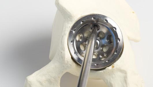 Trilogy IT Acetabular System Surgical Technique 9 After drilling the pilot or tapping the Screw hole: Use the Depth Gauge to measure the depth of the Screw hole. (Fig.