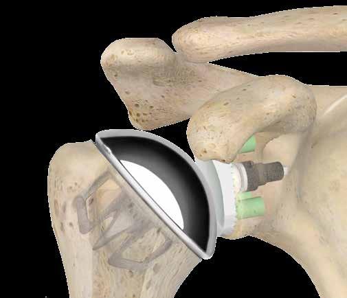 Sidus Stem-Free Shoulder Designed for anatomic flexibility and secure fixation 1 3 Position of Anchor is