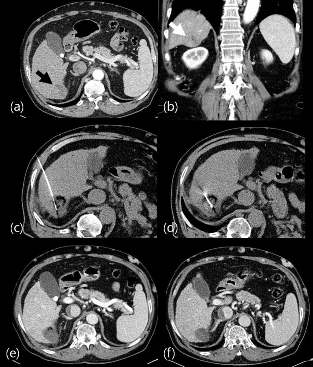 Fig. 4: Successful combination therapy of RFA and PEI in a 70-year-old man with high risk located HCC.