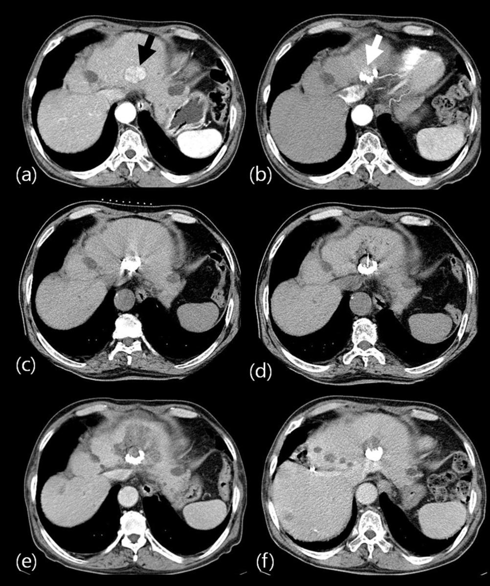 Fig. 2: Successful combination therapy of TACE plus PEI in a 76-year-old man with high risk located HCC and remnant viable portion after TACE.