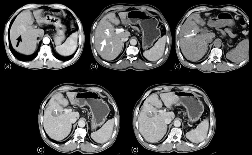 capsule. (b) Axial contrast enhanced CT scan after TACE shows partially accumulated iodized oil in the HCC.