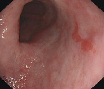 Second circumferential ablation in case of: circumferential disease > 2 cm; multiple islands or tongues.