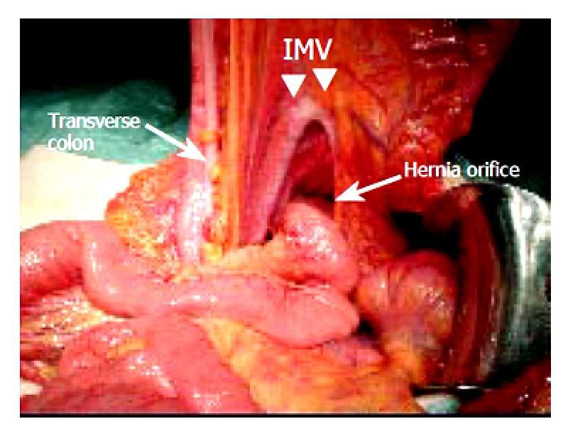 Large orifice of the hernia sac (white arrow) in the transverse mesentery