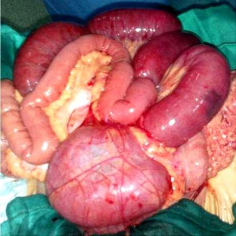Part of the jejunum was reduced, the other part is still in the