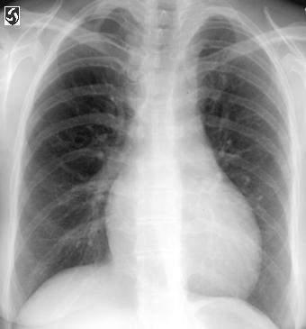Chest x-ray in more affected newborn babies usually shows cardiomegaly (widening of heart shape) and pulmonary congestion (See Diagnosis in Diagnosis and treatment).