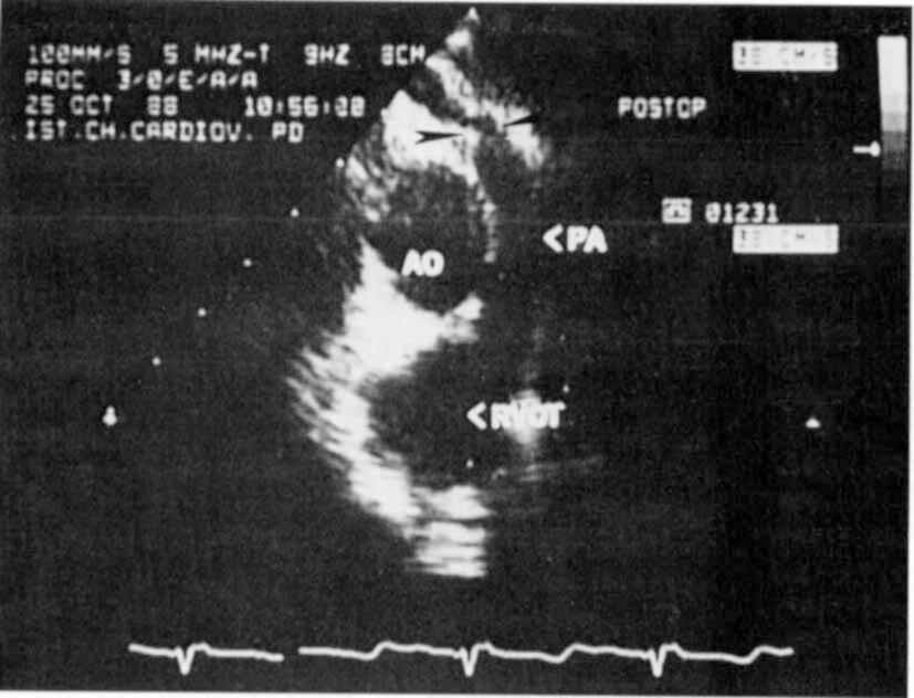 990;5063743 DANETAL 64 Fig 3, Transesophageal two-dimensional basal short-axis view after closure of a ventricular septal defect in a 7-year-old, 24-kg boy showing stenosis of the origin of the right