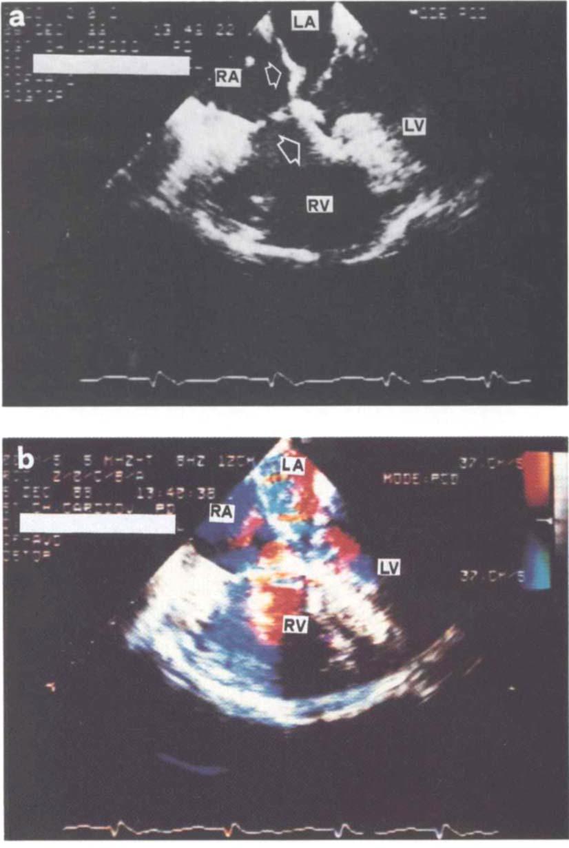 642 DANETAL 990;50:637-43 Fig 4. (a) Postoperative transesophageal two-dimensional four-chamber view in a 2-year-old, 50-kg boy with tetralogy of Fallot and complete atrioventricular canal.