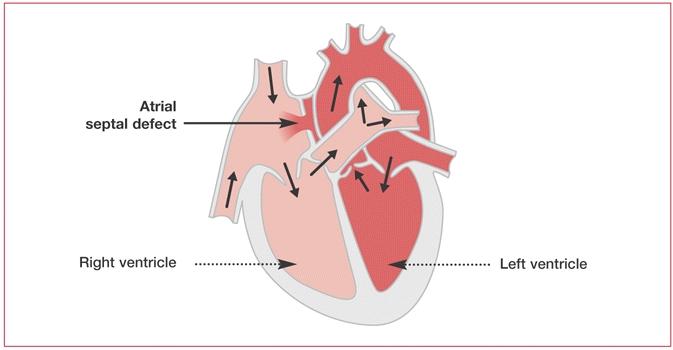 development of endocardial cushion area or junction between the four chambers of the heart Extent varies o Partial or complete o Simple defect is a defect in the lower portion of the atrial septum o