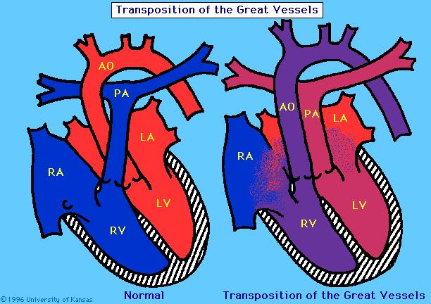 Truncus Arteriosus A single vessel arising from the heart that