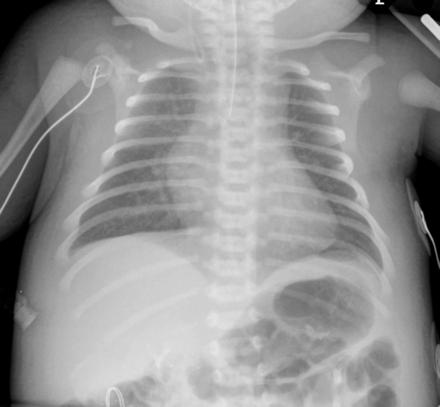 Another congenital heart defect that occurs with truncus