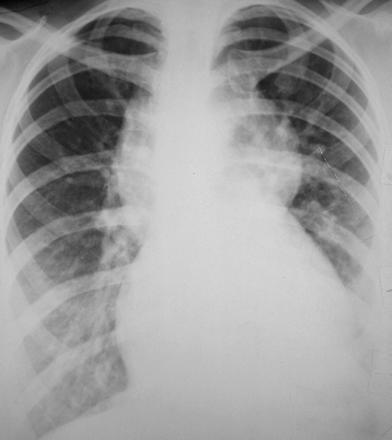 Tetraolgy of Fallot - TOF Pulmonary stenosis VSD (large) Overriding aorta