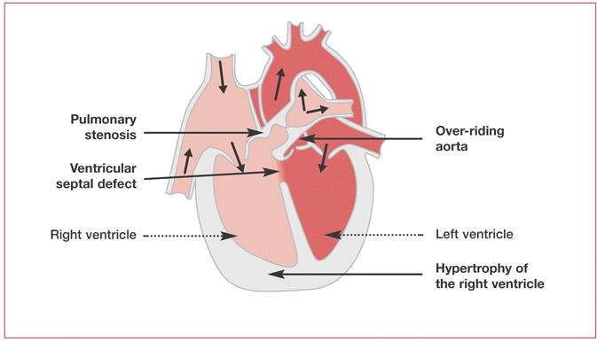 Associated with ASD/PFO right ventricular is usually hypoplastic Can have complex