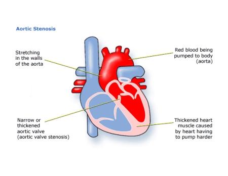 of the Aorta Aortic Stenosis Four ways: 1.