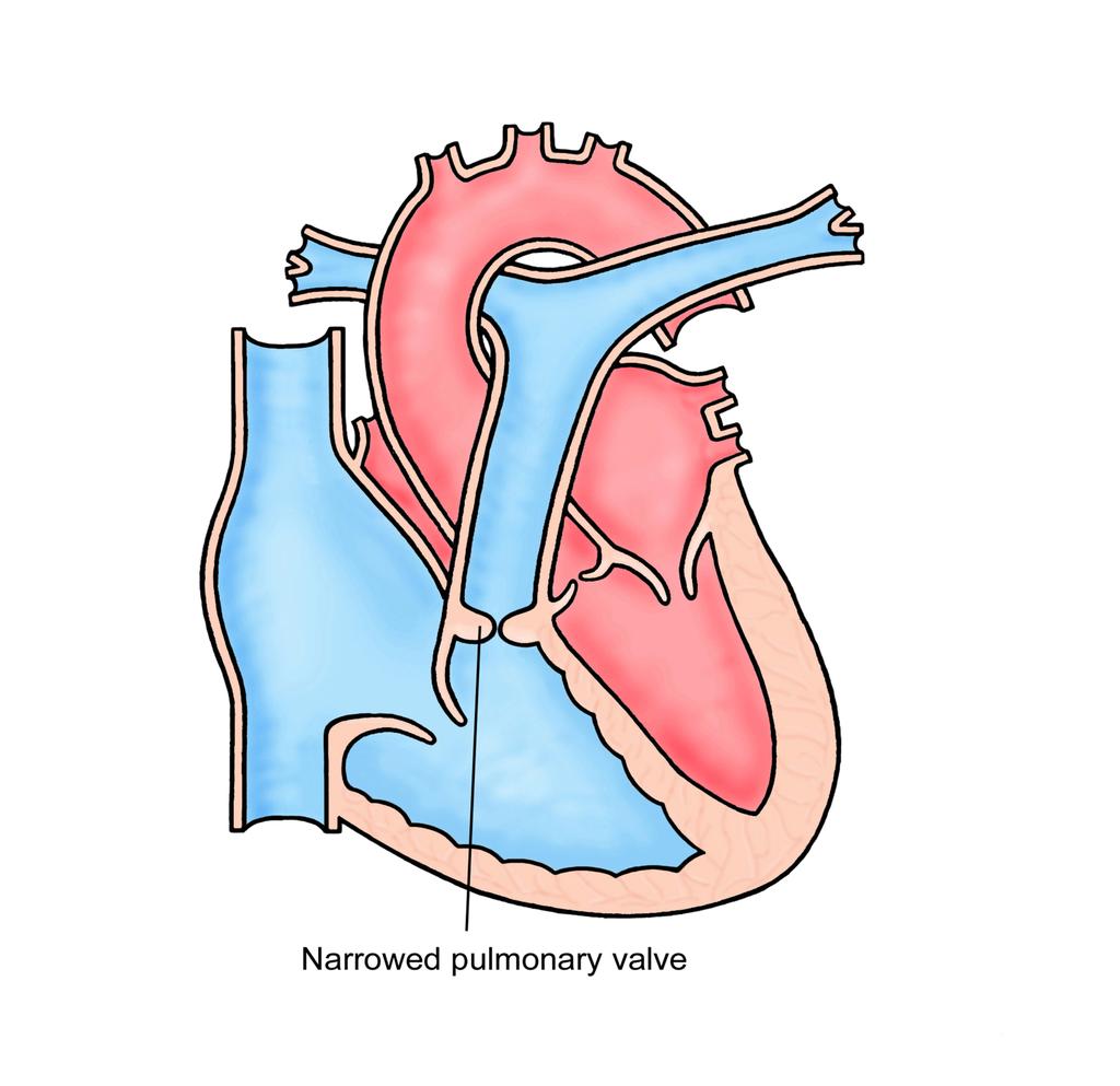 Pulmonary Stenosis Narrow opening in pulmonary valve due