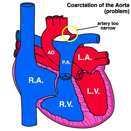 of tissue Coarctation of the Aorta Narrowed lumen,