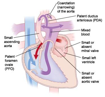 aortic valve occurs in about half the patients VSDs are