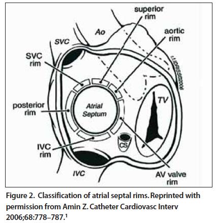 Sonographer Tip Imaging the Atrial Septal Defect (ASD) There are three kinds of atrial septal defects. They are: sinus venosus, ostium secundum, and ostium primum.