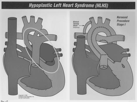 of the Aorta: 8-10% of CHD, M>F,