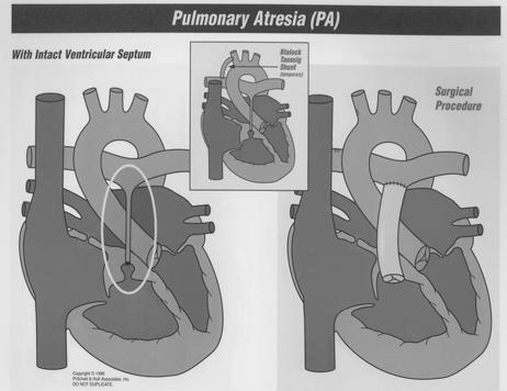 Right Ventricular Outflow Tract Obstructions Pulmonary atresia: if no