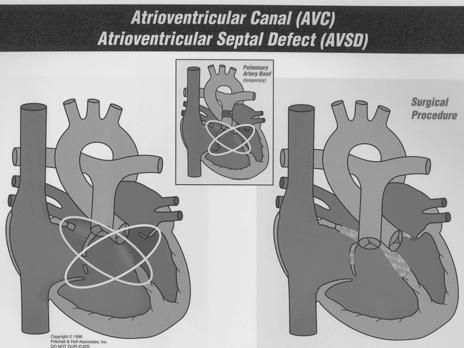 severely hypertensive in utero, coronary sinusoids Pulmonary stenosis: