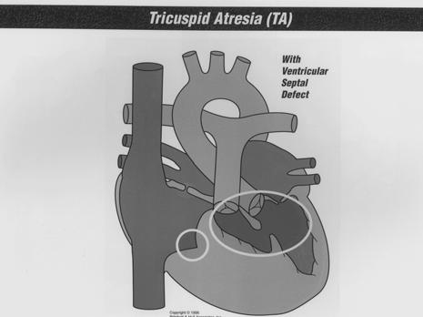 Atrioventicular Valve Abnormalities Common AV canal (endocardial cushion