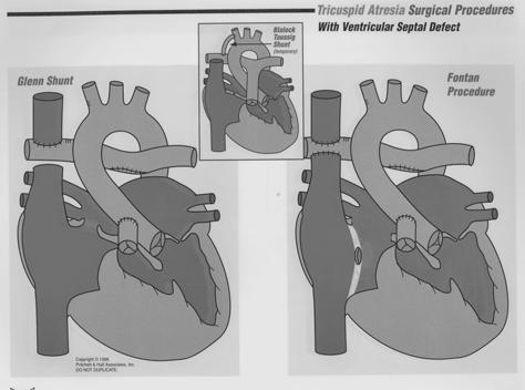 hypoplastic right heart Mitral stenosis/atresia: may be a cause of HLHS