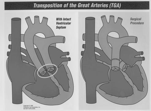 Complex Others Complete Transposition of the Great Arteries (TGA): may need urgent balloon septostomy Double Outlet Right Ventricle Heterotaxy syndromes Ventricular inversion (congenitally corrected