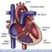 COMMON ATRIOVENTRICULAR CANAL Preoperative Pathophysiology Common Mixing Increased Pulmonary