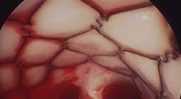 artery near phrenic nerve -Patch material can become calcified leading to