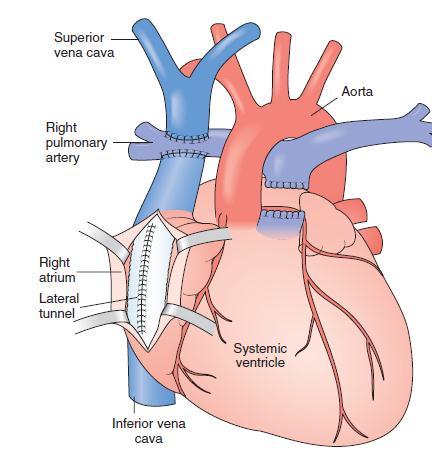 Fontan Physiology Anesthesia