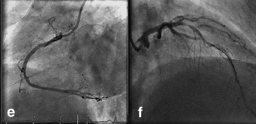 Myocardial perfusion territory and FFR AFTER 2 DES IN THE