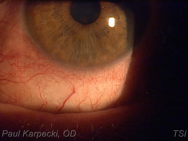 The SEVEN HABITS of Highly Effective Anterior Uveitis Management Case History! 68 y.o. Caucasian female of photophobia and blurred vision!