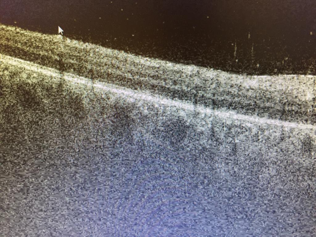 g. retinal tear or RD Examine the posterior pole for